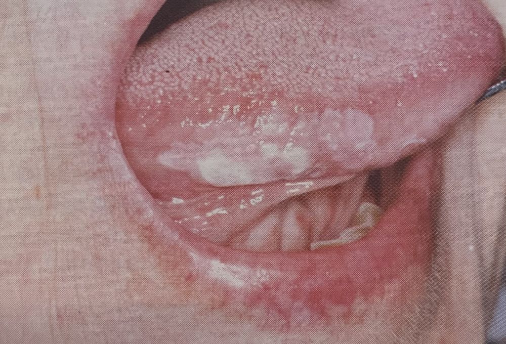 leucoplachia margine laterale della lingua